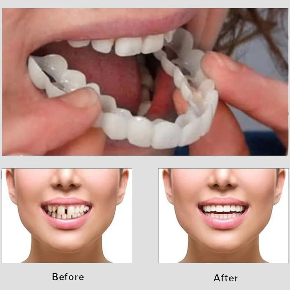 غطاء أسنان تجميلي فوري للحصول على ابتسامة طبيعية وأكثر إشراقًا